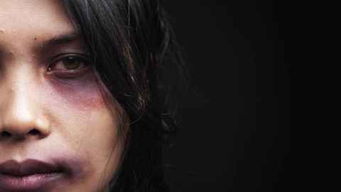A woman with facial bruising