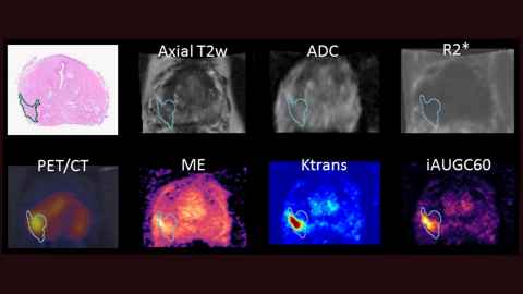 Figure 2: Prostate multiparametric MRI and PSMA PET/CT imaging data co-registered with ground truth histopathology data to validate the tumour location.