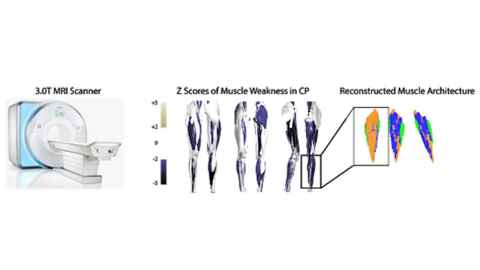 Figure 2: We use cutting edge techniques that integrate Magnetic Resonance Imaging with post-processing analyses based on fundamentals of muscle biomechanics. We create patient-specific mappings of muscle wasting in Cerebral Palsy. Recent work uses advanced MRI techniques to determine the in vivo muscle architecture of adolescents with CP.