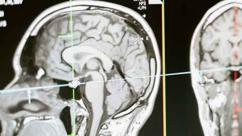 Brain scan