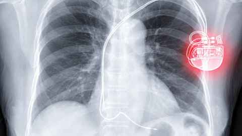 X-ray image of a chest with a pacemaker. 