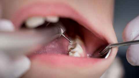 Dental instruments in a child's open mouth