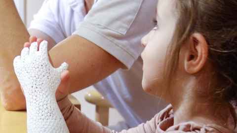 A child wearing a prosthetic forearm