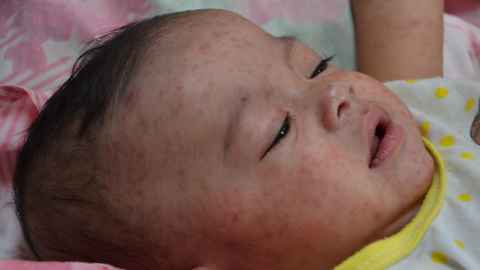 A child's face with measles
