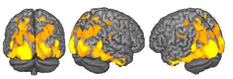 Images of the brain from three different aspects, with some areas highlighted in orange and yellow.