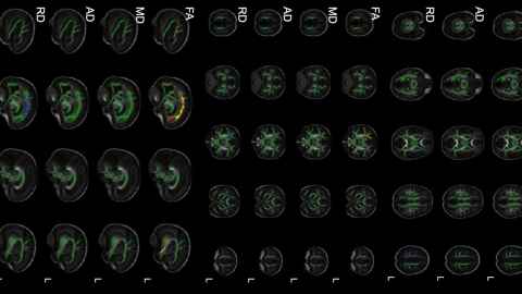 MRI scan of baby brains