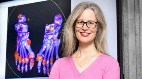 Professor Nicola Dalbeth with a scan showing gout in the joints of a patient's feet. 