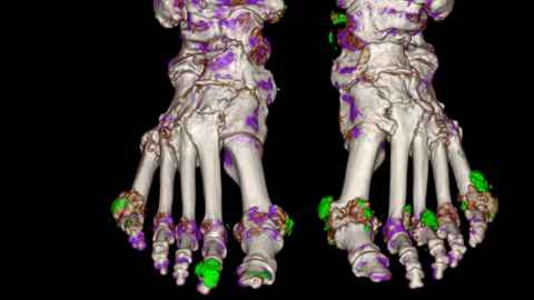A Dual Energy CT scan, showing uric acid crystals, in green, building up around the toe joints. 