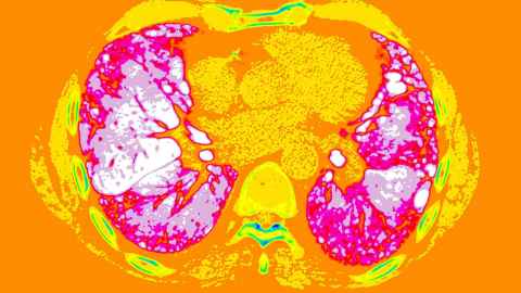Computer tomography image of lungs.