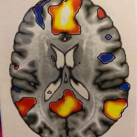 A scan of Karen Waldie's brain at rest. The colour blobs are areas called the Default Mode Network. Neurotypical brains show this activity at rest but when performing a mental task, these areas go off-line. But Karen's team research found this "uncoupling’" doesn’t happen with ADHD.