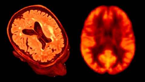 MRI images of the brain will be used to help predict dementia risk.