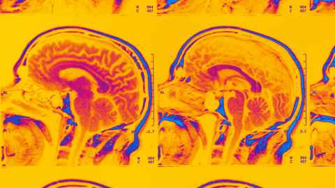Getty-1600-brain-scan