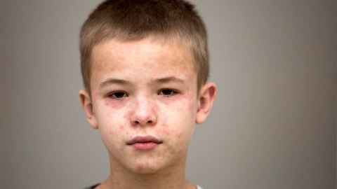 Image of young boy's face, with measles