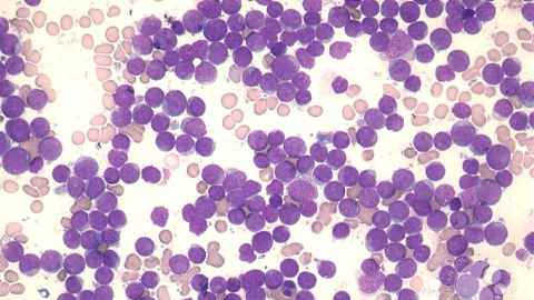 Rates of some blood cancers were 20 percent higher in patients from areas of high deprivation.   Image: ASH Collection.