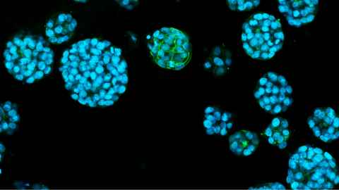 A breast cancer organoid. Image: Yohanka Perera.