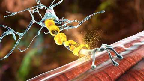 Microscopic image of deymelation on nerves