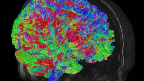 Noticeable differences appear in the brains of long-term meth users. Image: Mātai Medical Research Institute.