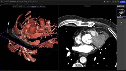 red 3D pic of a heart next to b&w scan picture